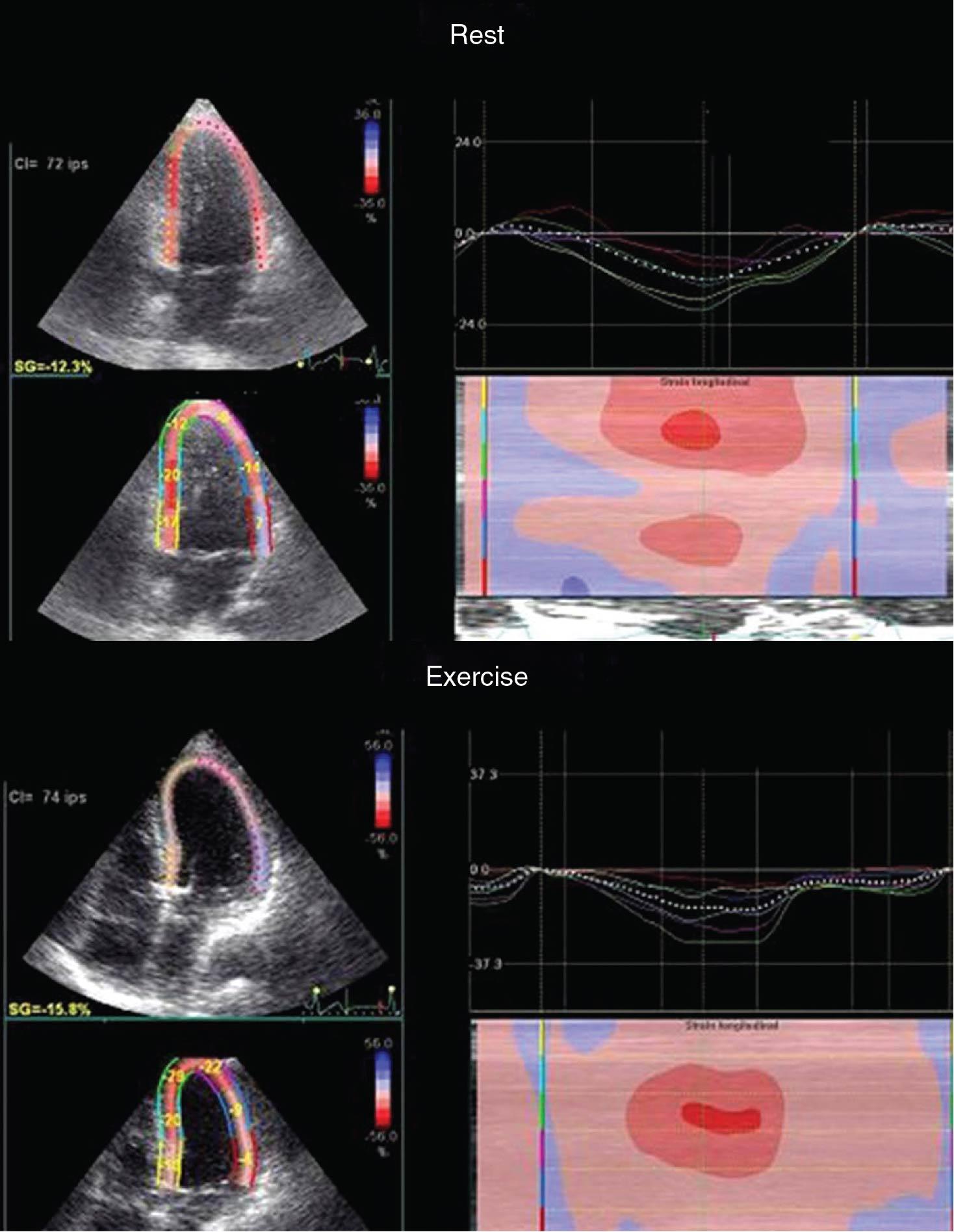 Fig. 4.6, Blunted exercise strain response in hypertrophic cardiomyopathy (HCM). Resting and exercise longitudinal strain in a patient with HCM, showing no increase in longitudinal strain during exercise.