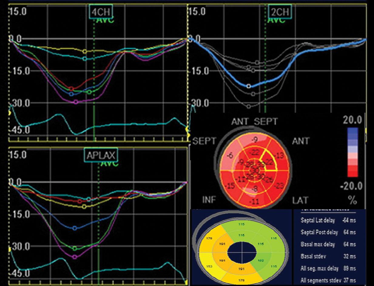 Fig. 4.7, Regional strain and delay in hypertrophic cardiomyopathy (HCM). This patient with HCM and nonsustained ventricular tachycardia (NSVT) shows significantly reduction of peak systolic strain in the basal septum and midseptum and basal anteroseptal segments. Although tissue synchronization imaging (left) shows no delay, the strain curves show contractile dispersion.