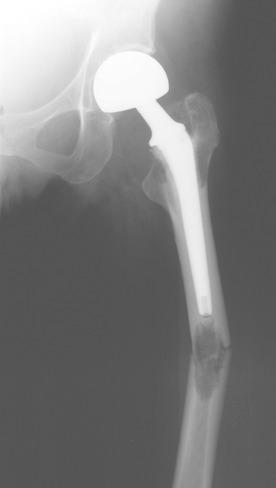 Fig. 48.1, Postoperative radiograph following treatment of pathologic femoral neck fracture; the surgeon failed to image the entire bone before surgery.
