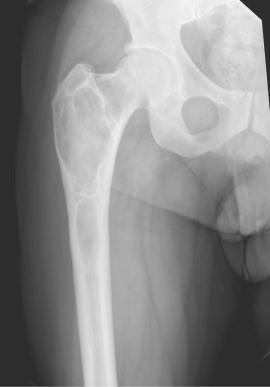 Fig. 48.2, Anteroposterior radiograph of the hip demonstrating a “ground glass” appearance with mild varus remodeling characteristic of fibrous dysplasia.