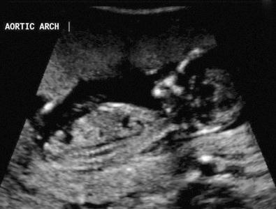 FIG 5-12, Normal aortic arch at 12 weeks.