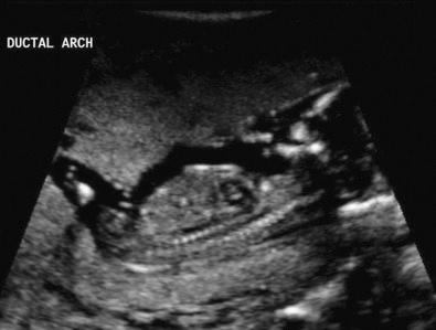 FIG 5-13, Normal ductal arch at 12 weeks.