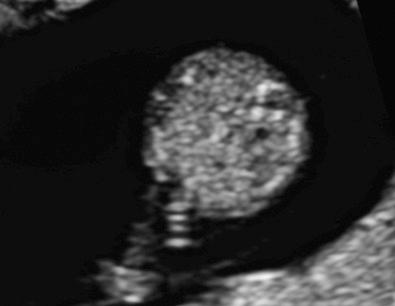 FIG 5-14, Axial view through the fetal abdomen at 13 weeks of gestation, demonstrating an intact abdominal wall and normal fetal cord insertion.