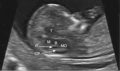 FIG 5-2, Ultrasound image of a normal fetal central nervous system in the midsagittal plane at 12 weeks' gestation. The thalamus (T), midbrain (M), brainstem (B), medulla oblongata (MO), and choroid plexus (CP) of the fourth ventricle are noted. The normal intracranial translucency (IT) of the fourth ventricle is present.