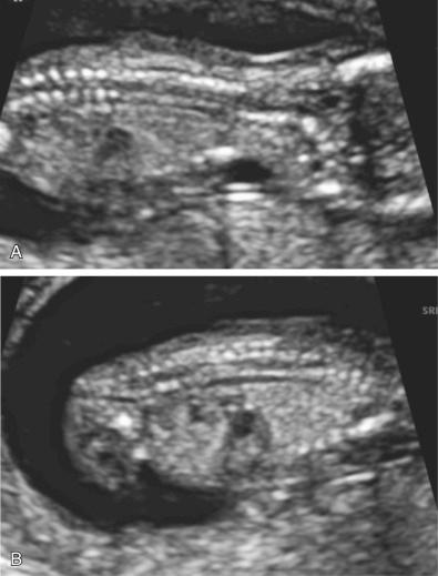 FIG 5-4, Normal fetal spine at 12 weeks' gestation. A. Cervical and thoracic spine. B. Thoracic and lumbar spine.