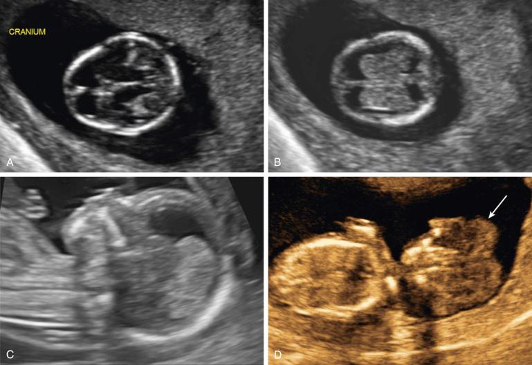 FIG 5-5, Fetal head at 12 weeks' gestation demonstrating a normal cranial vault ( A ) and normal choroid plexus ( B ). The midline falx is also demonstrated. C, The large echolucent area anterior to the choroid plexus is normal at this gestational age. D, This 13-week fetus has acrania or exencephaly, with absence of the cranial vault and irregular brain tissue floating in the amniotic fluid ( arrow ).