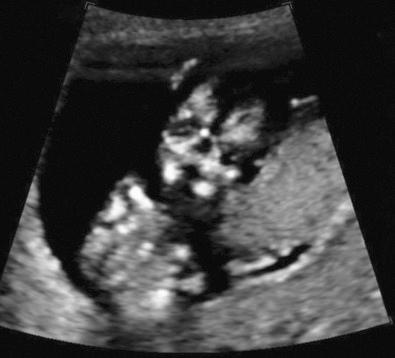 FIG 5-6, Coronal view of the normal fetal face at 12 weeks demonstrating the symmetry of the orbits, mandible, and maxilla.