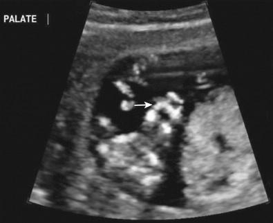 FIG 5-7, Normal fetal palate ( arrow ) at 12 weeks.