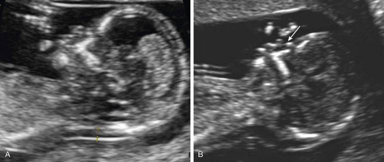 FIG 5-8, Nuchal transclucency (NT). A, Normal NT in a normal fetus. B, Enlarged NT and absent nasal bone ( arrow ) in a fetus with trisomy 21.
