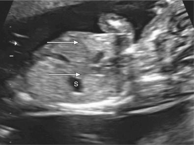 FIG 5-9, Image of the fetal chest and abdomen at 12 weeks demonstrating stomach (S) below the intact diaphragm ( arrows ).