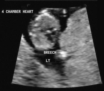 FIG 5-10, Four-chamber view of the heart at 12 weeks demonstrating normal cardiac axis of approximately 45 degrees. LT, left thorax.