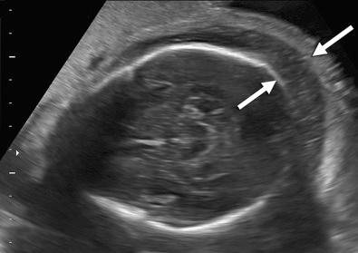 FIG 17-1, Scalp edema noted (between arrows ) at 32 weeks' gestation. Cause: idiopathic.