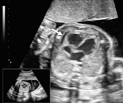 FIG 17-2, Cross-sectional view of the fetal thoracic cavity at 19 weeks' gestation. Note pericardial effusion ( arrow ). Also note the cardiomegaly. Cause: maternal RhD alloimmunization and resulting hemolytic disease of the fetus/newborn.