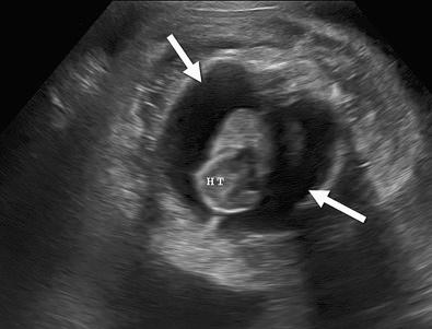 FIG 17-3, Bilateral pleural effusions ( arrows ) at 32 weeks' gestation. HT, midline fetal heart. Cause: idiopathic.