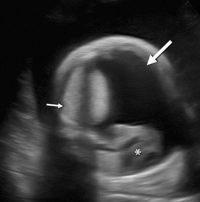 FIG 17-4, Predominantly left-sided pleural effusion ( large arrow ) at 30 weeks' gestation. Fetal heart ( asterisk ) is displaced to the right side of the chest. Large left-sided pulmonary sequestration is noted ( small arrow ). Note extreme polyhydramnios as well. Cause: intrathoracic mass with deviation of mediastinum.