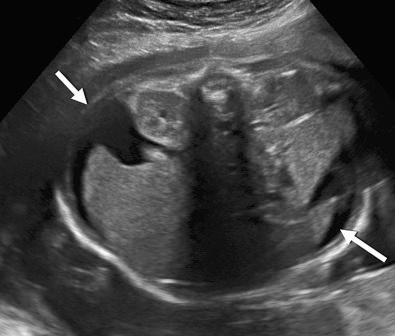 FIG 17-5, Cross-sectional view of the fetal abdomen at 32 weeks' gestation. Note ascites ( arrows ). Cause: fetal cytomegalovirus infection.