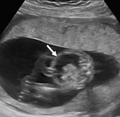 FIG 17-6, Cross-sectional view of the fetal abdomen at 19 weeks' gestation. Note ascites ( arrow ). Cause: trisomy 22.