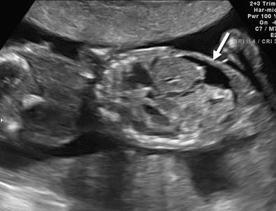 FIG 17-7, Longitudinal section of the fetal abdomen (fetal head on left) at 19 weeks' gestation—same fetus as illustrated in Figure 17-6 . Note ascites ( arrow ). Cause: trisomy 22.