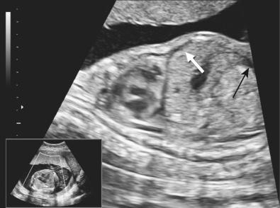 FIG 17-8, Longitudinal view of the fetal thorax and abdomen at 19 weeks' gestation (head on left of image). Note early ascites ( arrows ). Cause: maternal RhD alloimmunization and resulting hemolytic disease of the fetus/newborn.