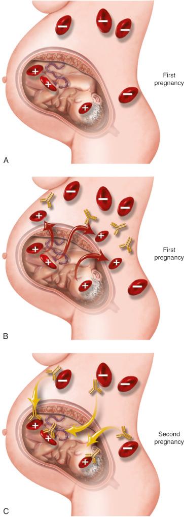 FIG 17-9, A, Initial pregnancy in which the mother is Rh negative and is carrying a fetus that is Rh positive. B, At the time of delivery, the fetal Rh-positive red blood cells enter the maternal circulation and initiate an antibody response. C, In a subsequent pregnancy, antibodies enter the fetal circulation, attaching to the red blood cells and resulting in the sequestration and destruction of these cells.