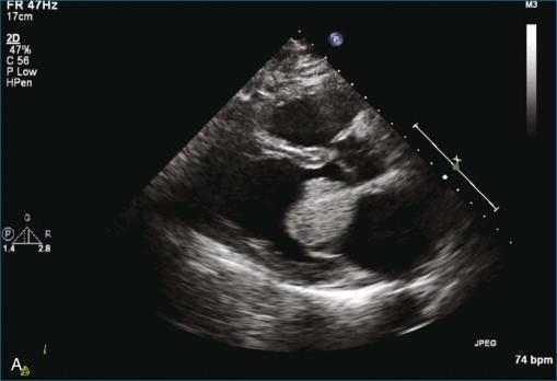 Figure 16-1, Left atrial myxoma imaging with two-dimensional echocardiography ( A ) and three-dimensional echocardiography ( B ) in the short-axis view (see Videos 16-1 and 16-2).