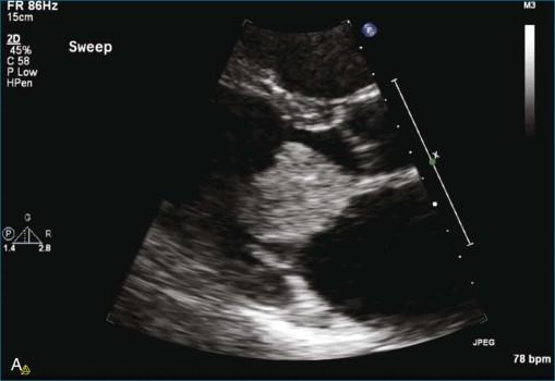 Figure 16-2, A, Zoom of two-dimensional echocardiography view of left atrial myxoma showing the attachment point of the mass to the left atrial wall ( B ). Note the attachment point to the left atrial wall has a close relationship to the anterior leaflet of the mitral valve and the posterior portion of the aortic annulus (see Video 16-3).