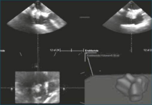 Figure 16-4, Volume rendering of the right atrial mass offline by TomTec (Munich, Germany) four-dimensional imaging showing that volume measurement can be performed. The result was 6.36 mL, comparable with the in vitro measurement of 6.4 mL.