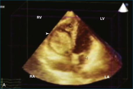 Figure 16-5, A and B, A right ventricular myxoma with involvement of the tricuspid valve. The tricuspid valve involvement was not appreciated by two-dimensional echocardiography. LV, left ventricle; RA, right atrium; RV, right ventricle.