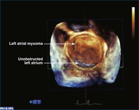 Figure 16-6, A giant myxoma of the left atrium causing obstruction of the mitral orifice.