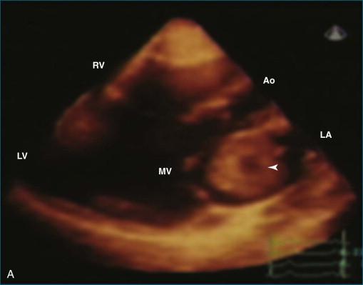 Figure 16-7, A and B, Example of echolucencies seen with cardiac masses suggesting intramass hemorrhage or necrosis of the tumor ( arrowhead ). Ao, aorta; LA, left atrium; LV, left ventricle; MV, mitral valve; RV, right ventricle.