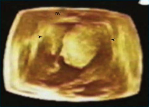 Figure 16-8, A right ventricular fibroma in a patient with history of previous incomplete resection of the same. The fibroma was much larger by three-dimensional compared with two-dimensional transthoracic echocardiography. RV, right ventricle.