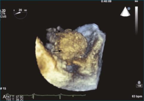 Figure 16-9, A, A left atrial fibroma ( arrow ) is shown by three-dimensional transesophageal echocardiography. This mass was associated with Gardner syndrome with familial adenomatous polyposis and associated extracolonic growths, including fibromas. B, Left atrial fibroma. LAA, left atrial appendage; A1, A3, anterior scallops 1 and 3; P1, P3, posterior scallops 1 and 3.