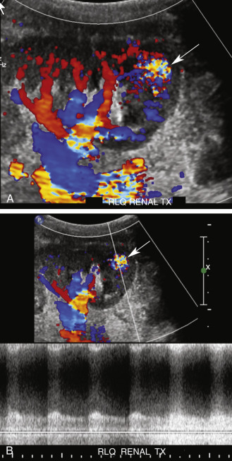 FIG. 31.14, Arteriovenous fistula (AVF). This patient with a renal transplant ( TX ) in the right lower quadrant ( RLQ ) underwent renal biopsy to assess the cause of renal failure 2 days previously. (A) Color Doppler image of the lower pole demonstrates a focal area of color aliasing ( arrow ) indicative of high-velocity flow. (B) spectral Doppler tracing from this area demonstrates an arterial waveform with high peak systolic and high end-diastolic velocity consistent with an arteriovenous shunt. These findings are diagnostic of an AVF ( arrow ) . The draining vein demonstrated a pulsatile high-velocity waveform (not shown). The amount of blood shunted through the fistula cannot be determined by Doppler ultrasound. Because most AVFs will close spontaneously, follow-up is generally recommended unless there are signs of graft ischemia, hematuria, or congestive heart failure, in which case percutaneous embolization is the treatment of choice.