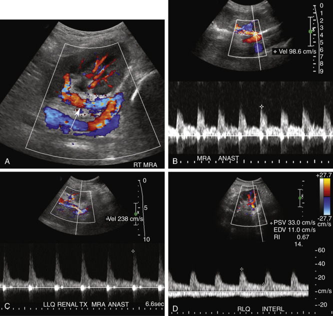 FIG. 31.2, Doppler ultrasound findings in a normal renal transplant. (A) End-to-side anastomosis of the main renal artery ( MRA ) ( arrow ) with the recipient external iliac artery. The transplant is located in the right ( RT ) lower quadrant. (B) In another patient, pulsed Doppler waveform at the arterial anastomosis ( ANAST ) has a sharp systolic upstroke, continuous forward diastolic flow, and a peak systolic velocity ( PSV ) of 99 cm/s. (C) In a third patient, PSV is higher, 238 cm/s, at the MRA anastomosis, but there was no narrowing on the gray-scale image, no distal turbulence or tardus-parvus waveform changes, and the patient did not have hypertension. In a normal patient, PSV may be elevated close to 200 to 250 cm/s at the MRA anastomosis, particularly immediately postoperatively. Increased PSV may be caused by slight torquing of the vessel, postsurgical edema, increased flow through the single artery, or secondary to acute angle of takeoff from the iliac vessel. (D) Pulsed Doppler tracing from an interlobar artery ( INTERL ) demonstrates a sharp systolic upstroke and continuous forward diastolic flow with a resistivity index ( RI ) of 0.67. Note intraparenchymal venous flow below the baseline. (E) Duplex Doppler image of the end-to-side venous anastomosis of the main renal vein ( MRV ) with the recipient external iliac vein reveals no narrowing and no color aliasing. Note transmission of respiratory variation. The spectral tracing may be flat, however, in some cases because of compression from the transplanted kidney. (F) Note tubular structure with two echogenic parallel lines ( arrow ) in the renal hilum. A stent ( arrow ) is often left for up to 3 months in the ureter to promote healing without stricture or extravasation of urine. Stent placement decreases the likelihood that a patient will develop a urinoma.