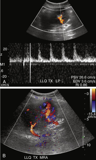 FIG. 31.7, Renal artery thrombosis. This living related donor transplant had two main renal arteries ( MRAs ) with separate end-to-side anastomoses with the recipient external iliac artery. (A) Postoperative baseline duplex Doppler examination in the recovery room demonstrates no evidence of flow in the parenchyma of the upper pole, and the more superior MRA could not be identified. Relatively poor diastolic flow with a resistivity index ( Ri ) of 0.86 is noted in a segmental artery to the lower pole ( LP ). The transplant is located in the left lower quadrant ( LLQ TX ). Findings are consistent with acute thrombosis of the MRA to the upper pole. It was thought that swelling of the upper pole caused compression of the LP, resulting in increased peripheral vascular resistance and decreased diastolic flow with resulting increase in Ri. (B) Following surgical thrombectomy, flow is restored to the upper pole and the superior MRA is now well seen. Note increased flow to the LP. EDV , End-diastolic velocity; PSV , peak systolic velocity.
