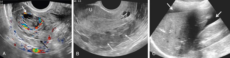 FIG 29-11, Ruptured hemorrhagic ovarian cyst. A, Color Doppler sonographic image demonstrating the “ring of fire” appearance of a hemorrhagic corpus luteum ( white arrow and calipers ), which is still recognized despite rupture. The ovary is not identified as a discrete structure as it is surrounded by complex material of mixed echogenicity compatible with blood clot ( black arrow ). B, Large amount of complex fluid containing echoes ( arrows ) compatible with blood in the cul-de-sac posterior to the uterus (U). C, Large amount of hemoperitoneum ( arrows ) in the upper abdomen adjacent to the liver and in the Morison pouch.