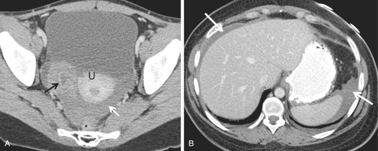 FIG 29-12, Ruptured hemorrhagic cyst at contrast-enhanced computed tomography (CT). A, An irregular, crenulated rim-enhancing cyst ( black arrow ) is visible in the right adnexa surrounded by a high attenuation blood clot. High attenuation fluid compatible with blood ( white arrow ) is present in the cul-de-sac posterior to the uterus (U). B, More superior CT image demonstrates blood in the upper abdomen adjacent to the liver and spleen ( arrows ).