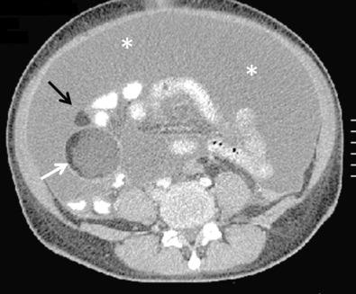 FIG 29-13, Ruptured mature cystic teratoma. Patient presented to the emergency department with diffuse abdominal pain. There is a fat density mass compatible with mature cystic teratoma in the right adnexa ( white arrow ). Note focus of fat density separate from the mass ( black arrow ) and large amount of ascites ( asterisks ). A ruptured mature cystic teratoma with associated peritonitis was identified at surgery.