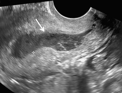 FIG 29-14, Endometritis. Distended endometrial cavity ( arrow and calipers ) containing complex predominantly hypoechoic fluid in a febrile patient with purulent vaginal discharge.
