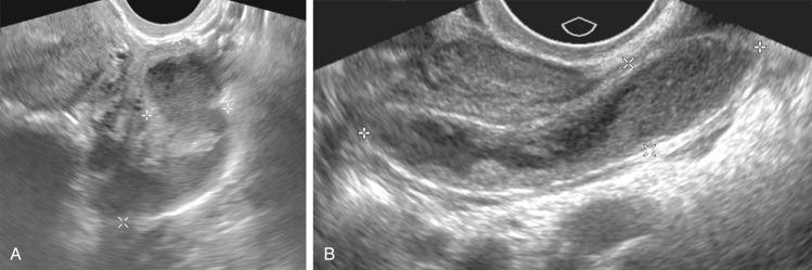 FIG 29-15, Pyosalpinx. A, Distended thick-walled fallopian tube ( calipers ) containing complex fluid compatible with pyosalpinx. B, Pitfall: acute appendicitis. Debris-filled tubular structure ( calipers ) in the right adnexa was initially thought to represent pyosalpinx. However, no endosalpingeal folds are identified and this is a blind-ending structure. Computed tomography scan (not shown) confirmed acute appendicitis.