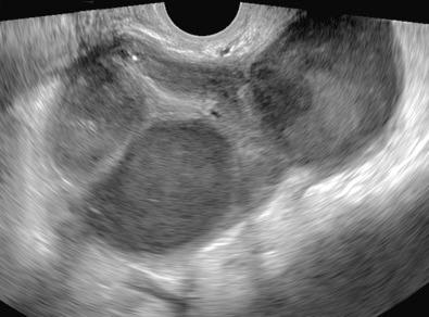 FIG 29-16, Tubo-ovarian abscess. Multiloculated adnexal mass containing complex fluid. No normal ovary was identified.