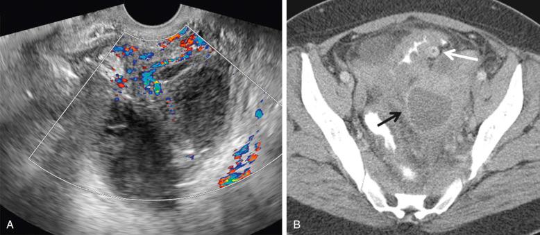 FIG 29-17, Tubo-ovarian abscess secondary to diverticulitis. A, Ultrasound image demonstrates a complex multiloculated pelvic mass with increased peripheral blood flow in a patient with left lower quadrant pain and fever. Note increased echogenicity in the surrounding pelvic fat consistent with inflammation. The patient had no risk factors for pelvic inflammatory disease. B, Computed tomography demonstrates the left pelvic abscess ( black arrow ). Note mural thickening of the adjacent sigmoid colon with numerous diverticula ( white arrow ) compatible with diverticulitis, which was the source of the abscess, confirmed at surgery.