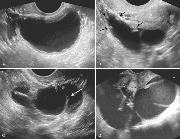 FIG 29-18, Sonographic spectrum of hydrosalpinx. A, Dilated fallopian tube appears as an anechoic fluid-filled, avascular tubular structure ( calipers ). B, The endosalpingeal folds ( arrows ) appear as beads on a string. C, Incomplete septation ( arrow ) is formed by the tube folding upon itself. D, Pitfall: mucinous cystadenoma ( calipers ) appears tubular in configuration with incomplete septations and mimics a distended fallopian tube.