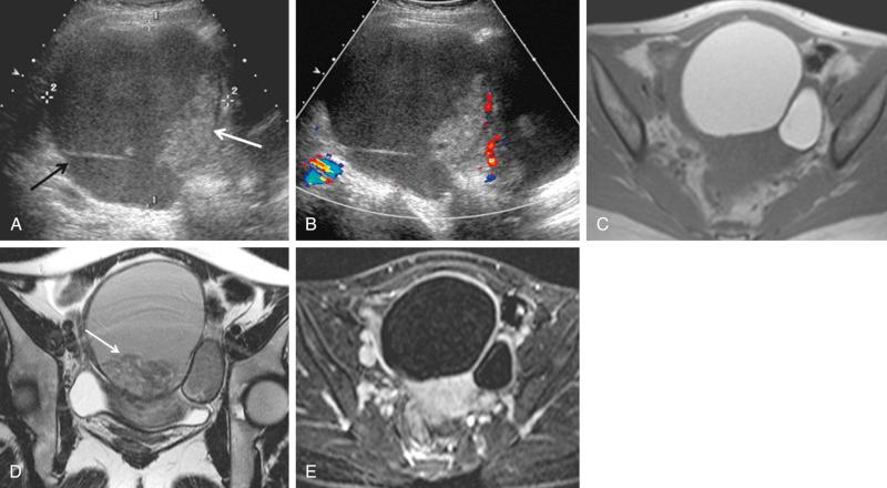 FIG 29-21, Complex endometrioma mimicking ovarian neoplasm. A, A 10-cm complex cystic mass ( calipers ) with septation ( black arrow ) and echogenic, lobulated mural nodule ( white arrow ). B, No flow was demonstrated in the nodule with color Doppler interrogation, suggesting the possibility of an adherent blood clot. C, Axial T1-weighted magnetic resonance (MR) image demonstrates that the lesion is T1-weighted hyperintense suggesting hemorrhagic content. Note adjacent smaller similar appearing lesion. D, Decrease in signal intensity within both lesions on T2-weighted axial MR image represents “shading.” A dependent clot is visible in the larger midline lesion ( arrow ). E, Postcontrast subtraction image demonstrates no enhancing solid component. Endometriomas were confirmed at surgery.