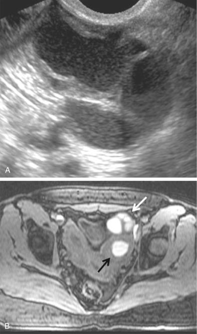 FIG 29-22, Endometriosis involving fallopian tube with hematosalpinx. A, Dilated fallopian tube with low-level intraluminal echoes compatible with blood. B, Axial fat-suppressed T1-weighted magnetic resonance image confirms high signal intensity in the tube ( white arrow ) compatible with hematosalpinx. The patient also has a unicornuate uterus with an obstructed left rudimentary horn containing blood ( black arrow ).