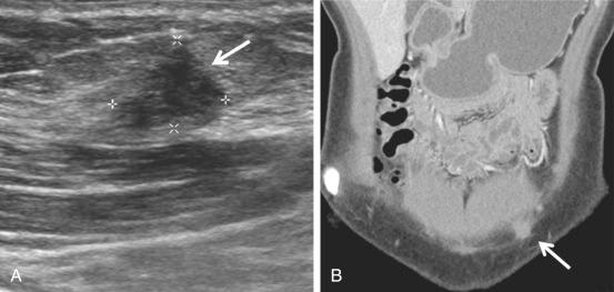 FIG 29-23, Abdominal wall endometriotic implant. A, Hypoechoic, irregularly marginated solid nodule ( arrow and calipers ) in the subcutaneous soft tissues at the anterior abdominal wall, ventral to the rectus muscle near the surgical scar. The patient, with history of open myomectomy 2 years prior, has a palpable lump. B, Coronal computed tomography image demonstrates the nodule ( arrow ) in the subcutaneous soft tissues, corresponding to the finding on ultrasound imaging.