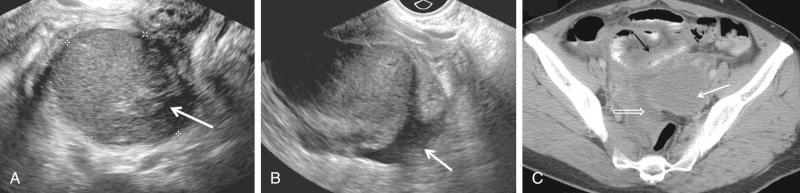 FIG 29-25, Ruptured endometrioma in a patient with acute onset of left lower quadrant pain A, Complex mass ( calipers ) with internal echoes and echogenic focus compatible with clot ( arrow ). B, There is associated free fluid ( arrow ) containing echoes, most consistent with hemoperitoneum. C, Computed tomography shows the endometrioma ( solid white arrow ). There is a small amount of free fluid ( open arrow ) and pelvic inflammatory changes. There is reactive thickening of an adjacent loop of small bowel ( black arrow ). Ruptured endometrioma was confirmed at surgery.