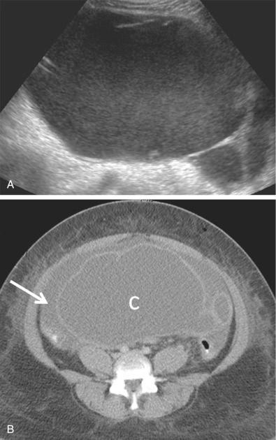 FIG 29-26, Infected endometrioma with rupture in a patient with abdominal pain and sepsis. A, Ultrasound image shows a large complex cystic mass with low-level echoes and incomplete septation. B, Computed tomography demonstrates the large cystic mass (C) with incomplete septation anteriorly and associated ascites ( arrow ). Ruptured endometrioma with superinfection was confirmed at surgery.