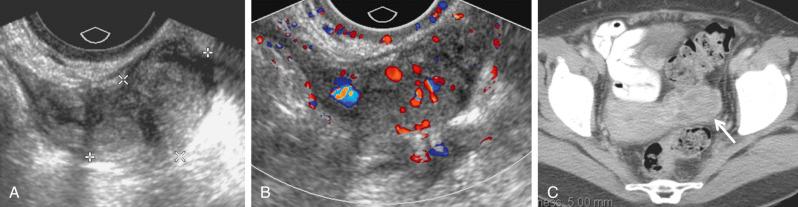 FIG 29-27, Enlarging solid ovarian mass found on serial sonograms in patient with history of endometriosis. A, Transvaginal sonography demonstrates a solid mass ( calipers ) in the left ovary. B, Increased vascularity is demonstrated in the mass with color Doppler sonography, confirming solid nature. C, Contrast-enhanced computed tomography scan demonstrates the primarily solid, heterogeneously enhancing left ovarian mass ( arrow ). Patient underwent surgery and was found to have endometrioid adenocarcinoma with foci of squamous and clear cell differentiation involving the left ovary and fallopian tube arising in a background of endometriosis.