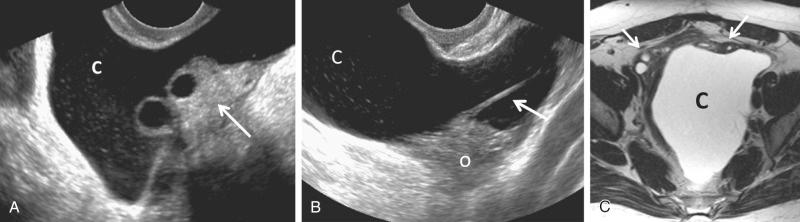 FIG 29-28, Peritoneal inclusion cyst. A, Normal ovary ( arrow ) identified at the margin of the cyst (c), which contains a small amount of echogenic debris. B, A fibrous band ( arrow ) extends from the ovary (o). The irregular shape of the cyst (c) conforms to adjacent pelvic structures. C, T2-weighted axial magnetic resonance image demonstrates both ovaries ( arrows ) along the anterior wall of the cyst (c).